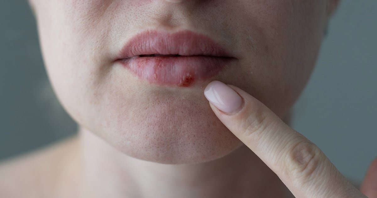 Después de casi treinta años, llega un antiviral oral distinto para el herpes que no responde a los tratamientos clásicos